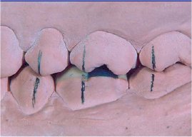 Ceratura del primo molare inferiore 