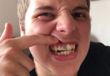 Perché i denti diventano neri